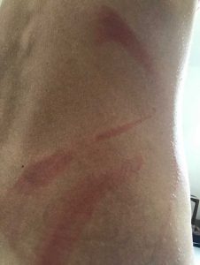 tomcat burns